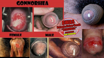 Obat Gonorhea Herbal