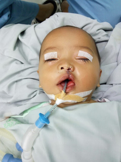 Rasya Aditya Putra setelah di operasi