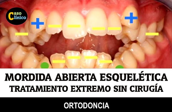 MORDIDA ABIERTA ESQUELÉTICA: Tratamiento Ortodóncico Extremo sin cirugía