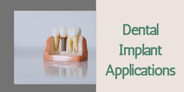 Dental Implant Applications