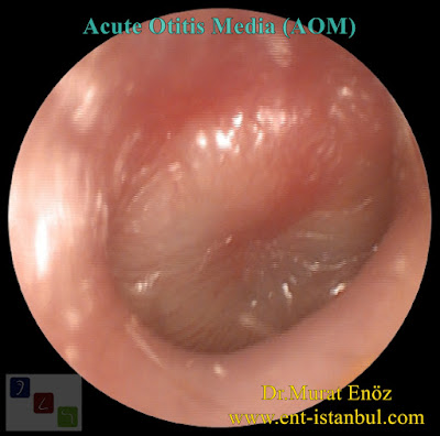 Middle Ear Infection in Children