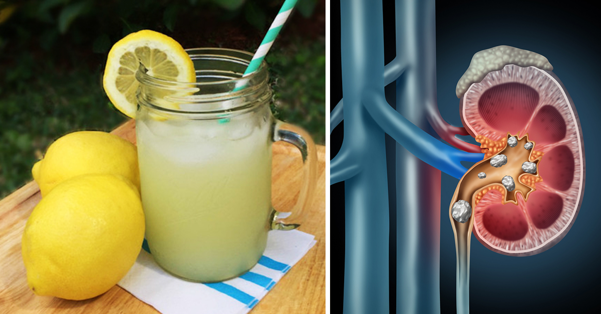 10 Natural And Economical Remedies To Prevent Kidney Stones (Including
