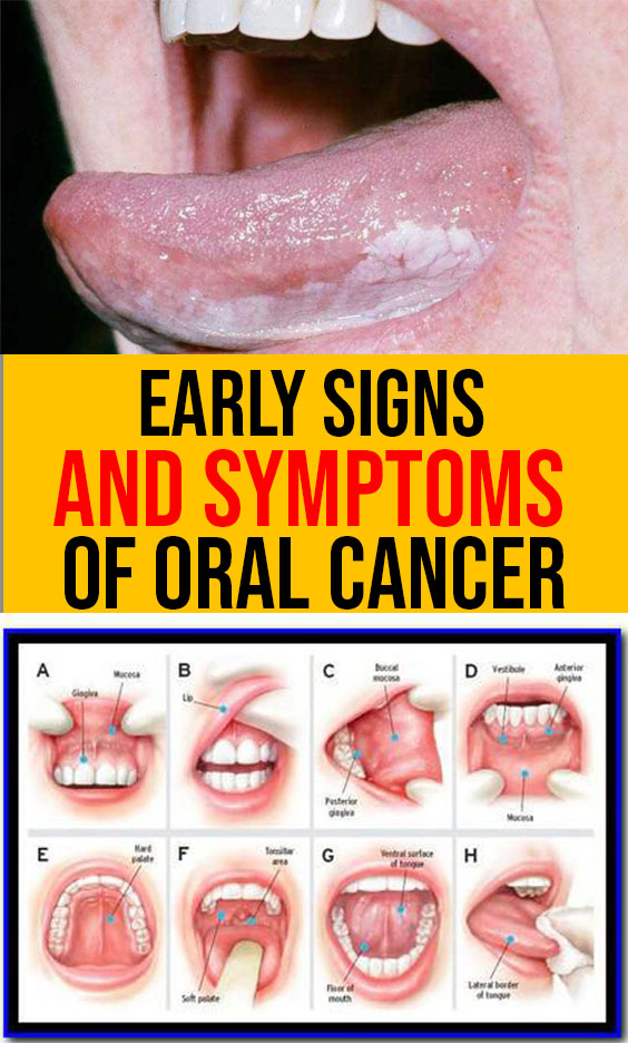Early Signs And Symptoms Of Oral Cancer Natural