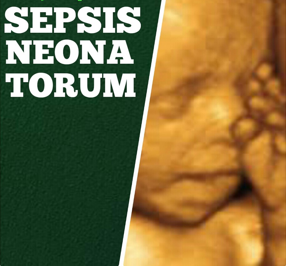 Nursing Care Plan for Sepsis Neonatorum NURSING CARE