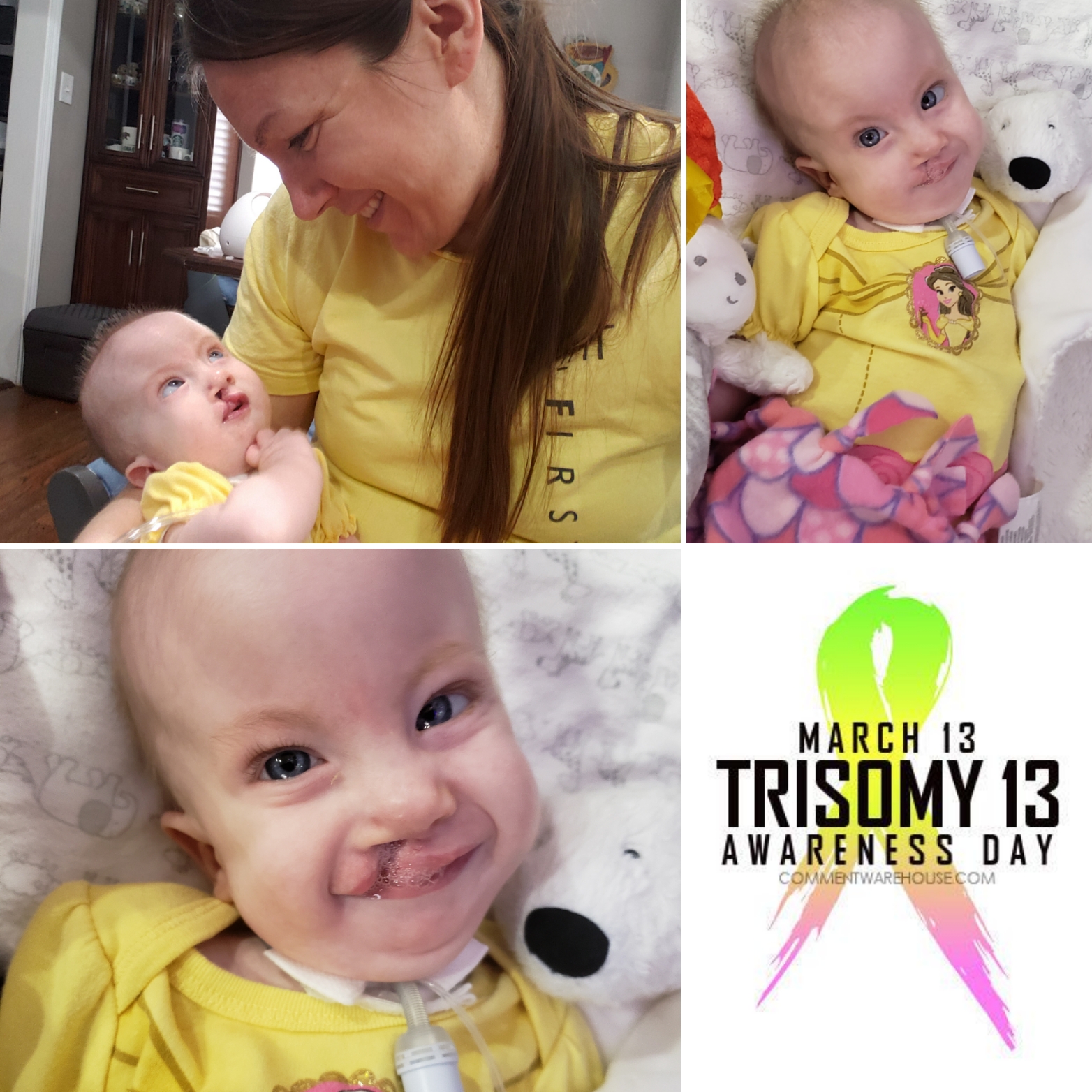 Collection 93+ Pictures Pictures Of Babies With Trisomy 18 Stunning