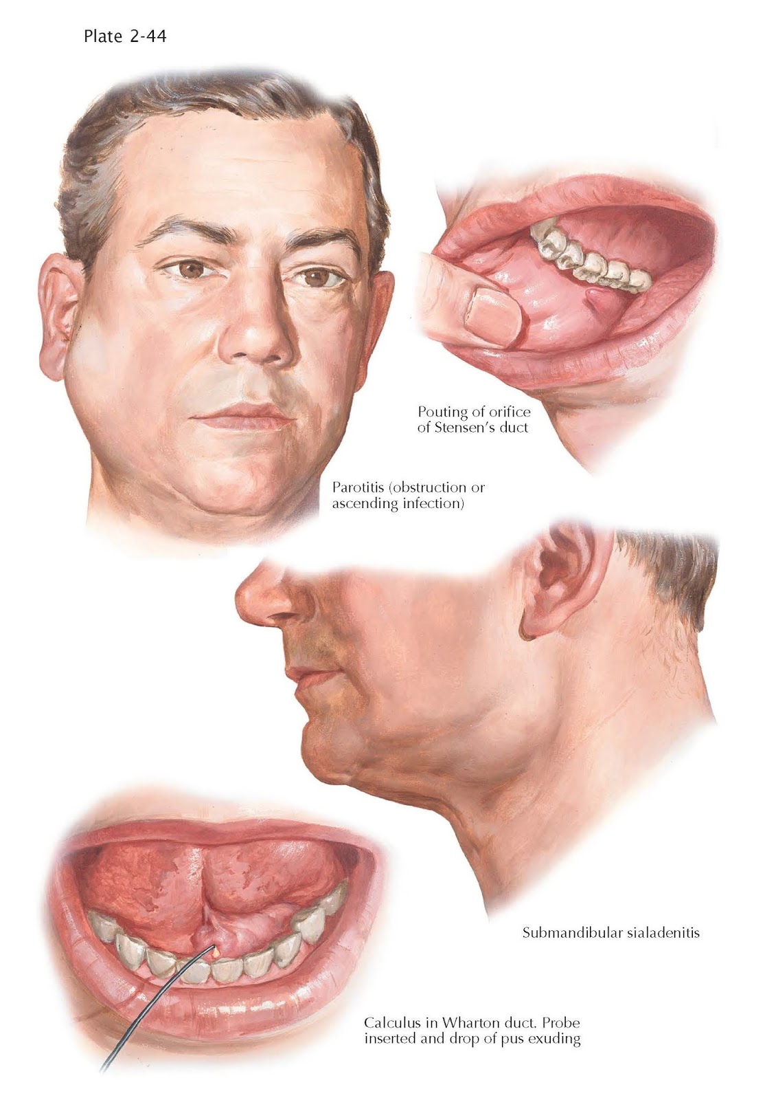 Inflammation of Salivary Glands pediagenosis