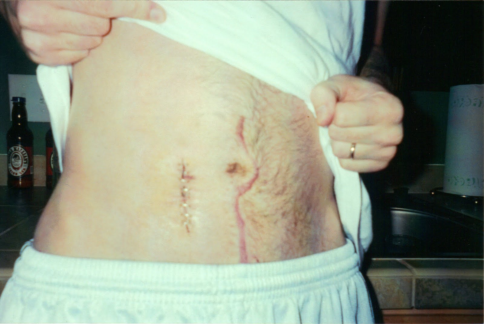 ONE STEP AT A TIME MARK'S STORY