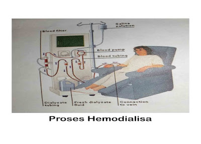 Manfaat dan Proses Hemodialisa ( cuci darah ) sampai komplikasi Manfaat dan Proses Hemodialisa