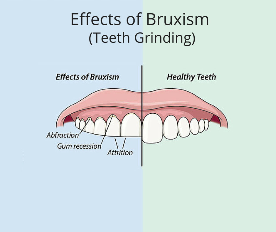 dentist Teeth Grinding or Effects Of Bruxism