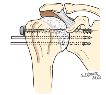 Shoulder Arthritis / Joint Replacement : Shoulder fusion - difficult ...