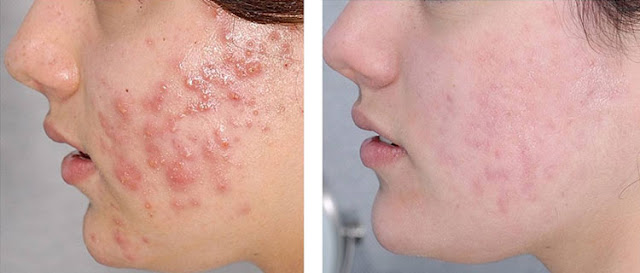 8 Foods That Help Prevent Acne Breakouts 8 Foods That Help Prevent Acne Breakouts