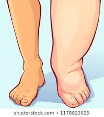 What is Edema, causes and formation Edema is increased fluid in the interstitial tissue spaces or it is a fluidaccumulation in the body cavities in excessive amount