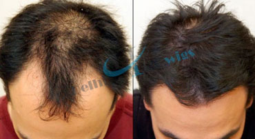 Hair Weaving In Faridabad Hair Weaving Cost In Faridabad Hair