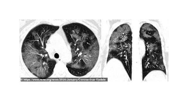 Naudzubillah ! Ternyata Virus Corona Tetap Hidup di Paru-paru Korban yang Meninggal Dunia