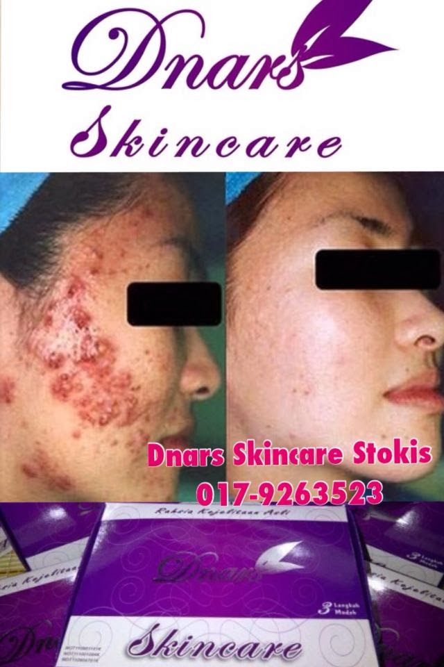 TESTIMONI DNARS SKINCARE