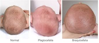 Come scegliere il cuscino più adatto per i neonati per prevenire la  plagiocefalia (testa piatta) ~ Da Mamma a Mamma