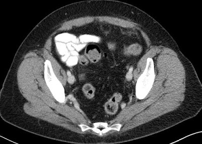 Peritoneal metastases from ovarian cancer