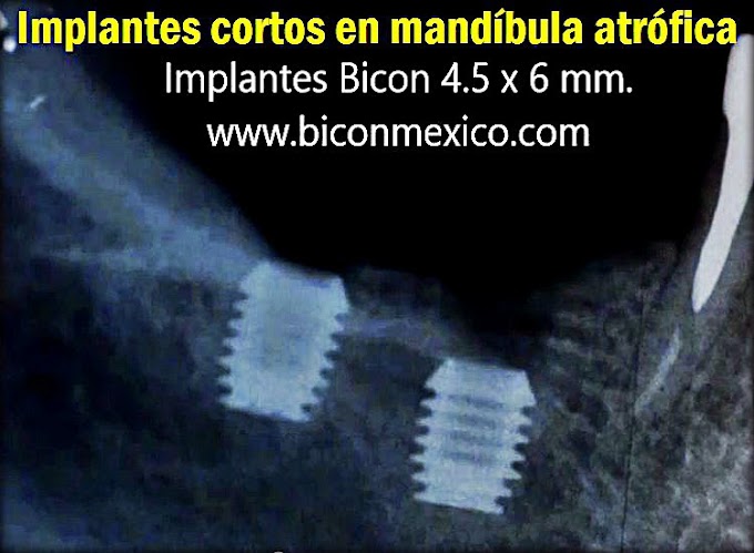 IMPLANTES CORTOS en mandíbula atrófica (Fotogalería)