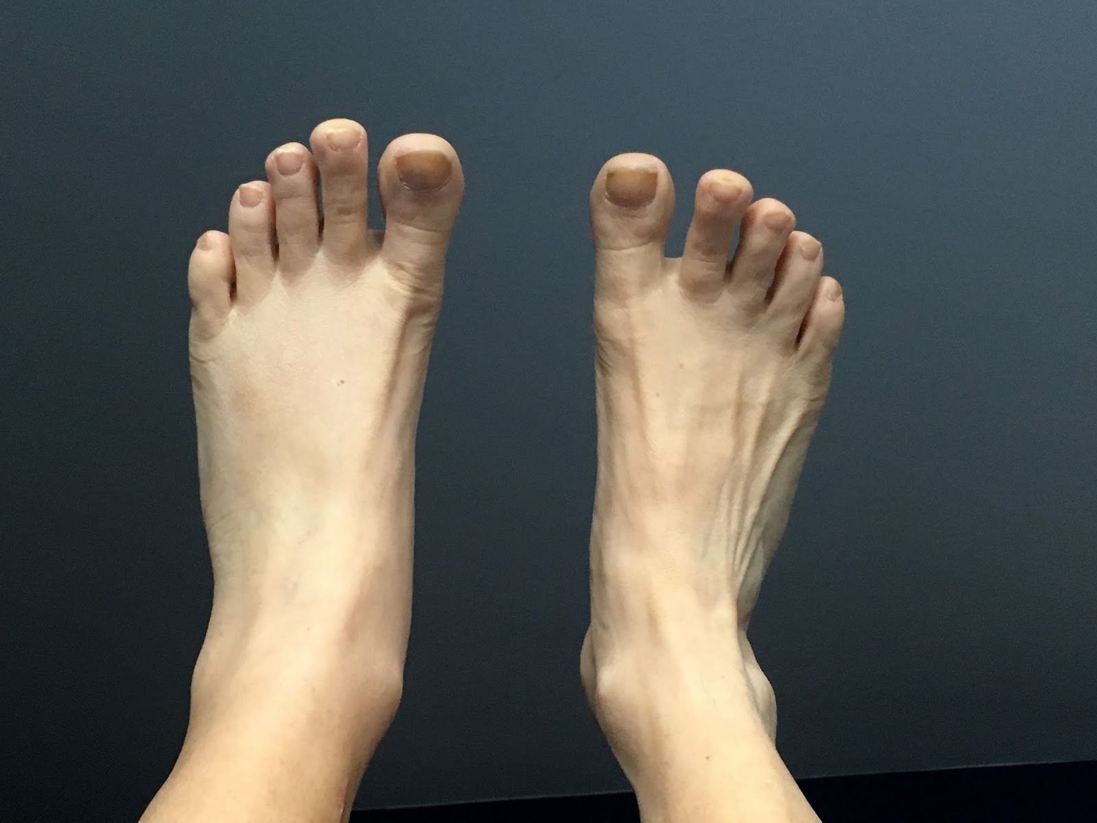 Femoral Popliteal Bypass My Recovery Timeline from FemPop Surgery 2017