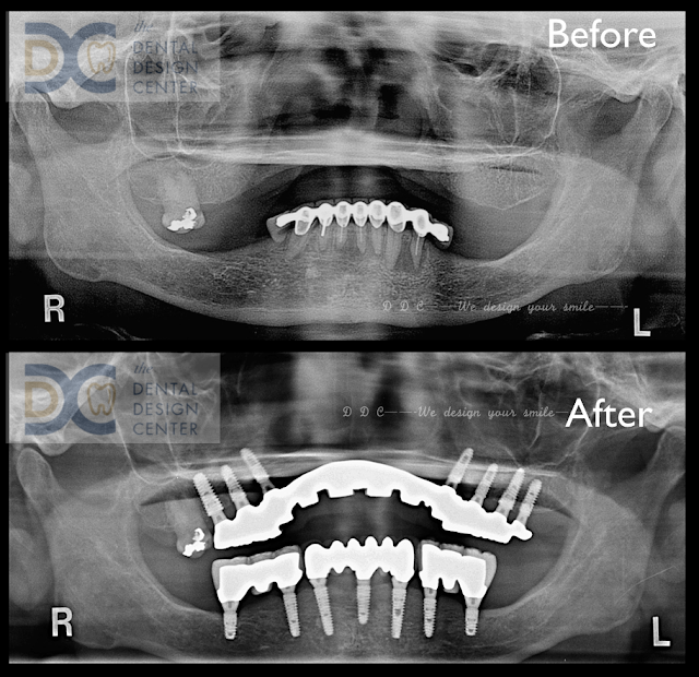 Full mouth implants in severe maxillary resorbed ridge 37 Screen%2BShot%2B2560 02 02%2Bat%2B6.48.23%2BAM