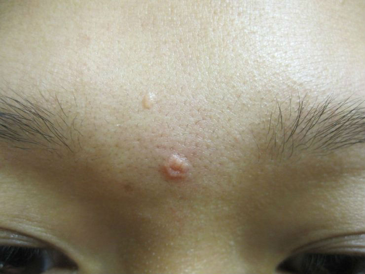 Skin Care Tips Sebaceous Hyperplasia Causes and Treatments