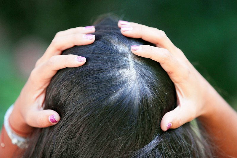 Los combatir alopecia femenina | FLANLATE