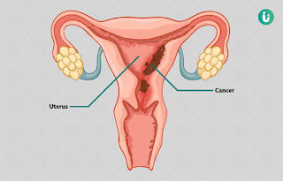 Carcinoma of the uterus Symptoms and Causes