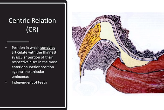 MAXILO-MANDIBULAR RELATIONS: Occlusion & Articulators