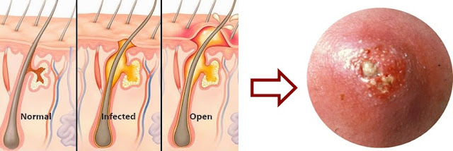 Rekomendasi Terbaru Cara Menyembuhkan Bisul Secara Efektif Dan Cepat Sampai Tuntas (Obat Bisul)