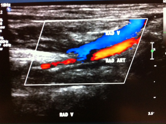 SonoPro: Upper Extremely Venous Ultrasound Scan Protocol