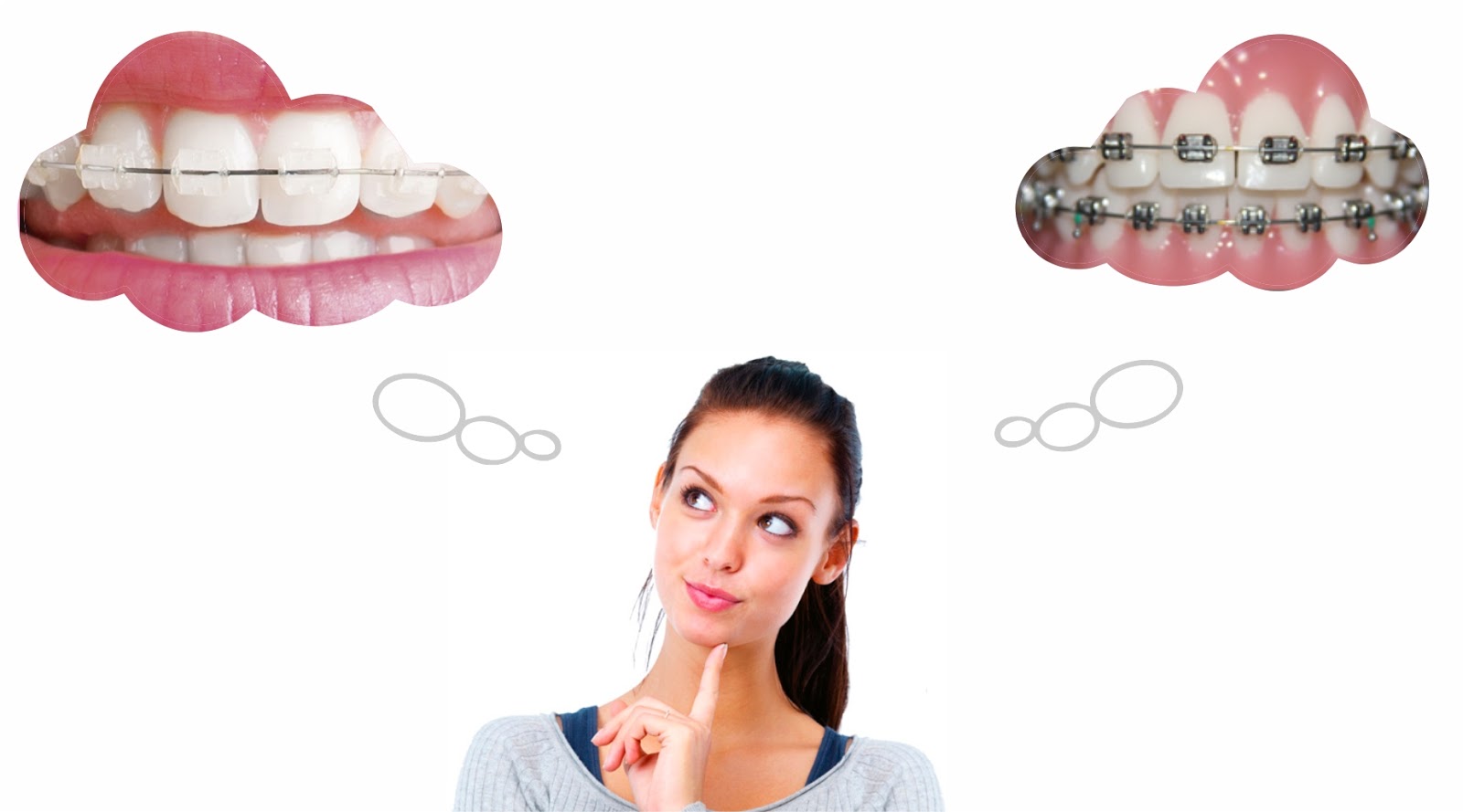 Brackets cerámicos (estéticos) o Brackets metálicos. ¿Cuales elegir?