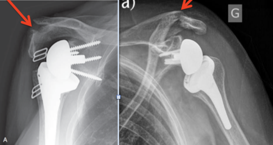 UW Shoulder and Elbow Academy Scapular fractures after reverse total
