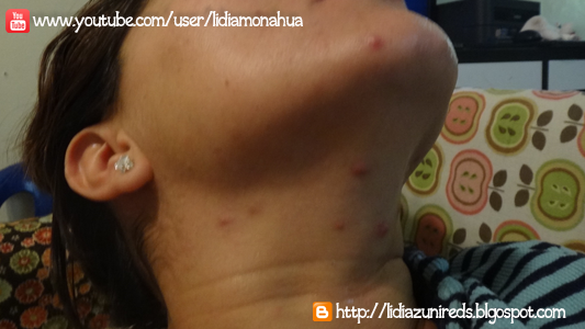 tratamiento que uso para el ácne