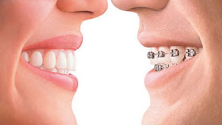 Sức khỏe, đời sống: Niềng răng mất bao lâu Nieng-rang-gia-re-2