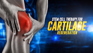 Stem Cell Treatment for knees