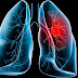 Triệu chứng và cách điều trị bệnh ung thư phổi