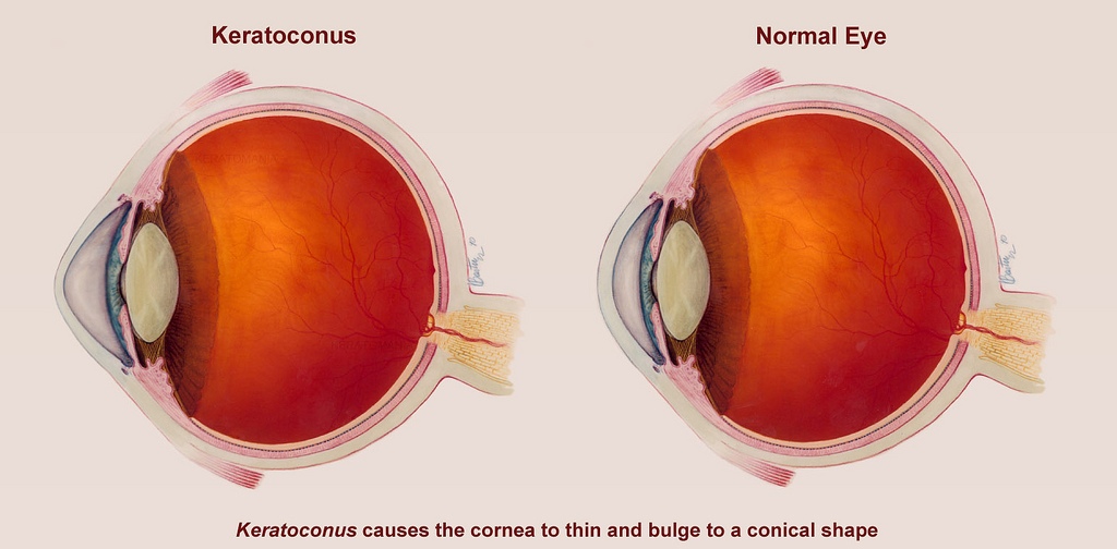 MBBS DOCTORS Keratoconus Window and Scissor Reflexes in Cornea