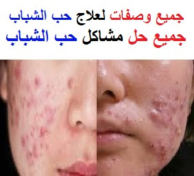 تكوين حب الشباب وعلاج الأشقاء في يوم منظمة سجفبكا
