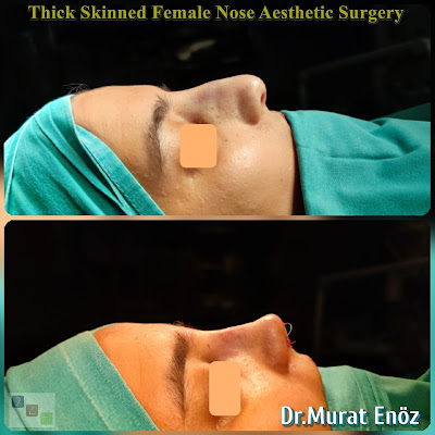 Rhinoplasty In Istanbul,Nose job in İstanbul,Nose aesthetic surgery Turkey,