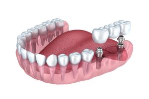 multiple tooth implants
