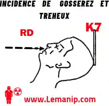 VARIANTE (Incidence de GOSSEREZ et TREHEUX)