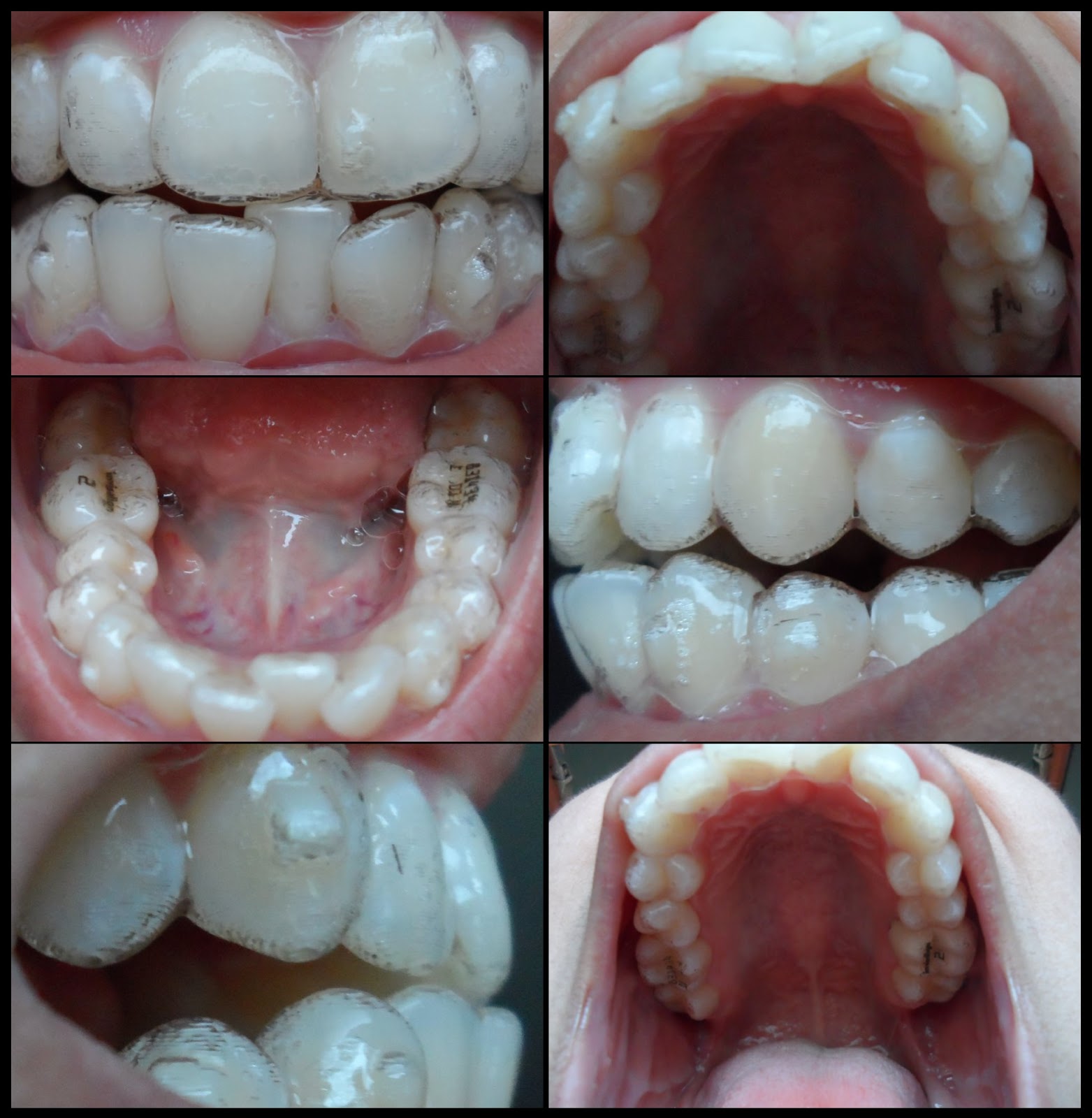 Ana's Invisalign Journey Tray 1 with Attachments/Buttons