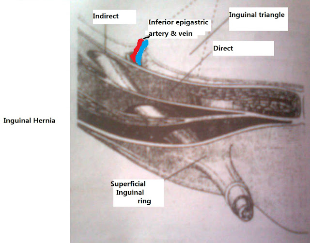 MBBS Medicine (Humanity First): Difference between Inguinal Hernias