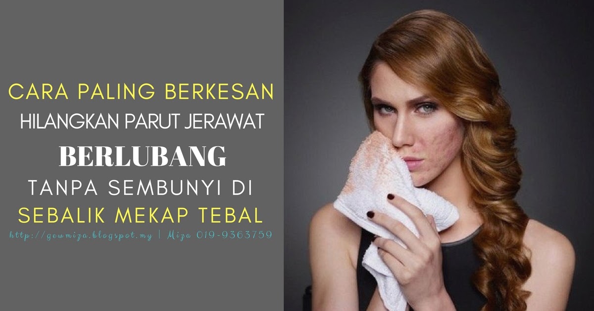 Cara Nak Hilangkan Jerawat Dengan Ubat Gigi Harbolnas b