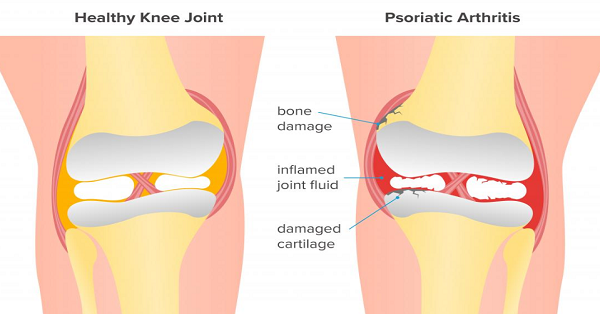 Arthritis Adalah Umum Yang Terjadi Pada Orang Orang Yang Merobek Ligamen Lutut Rafi Abadi