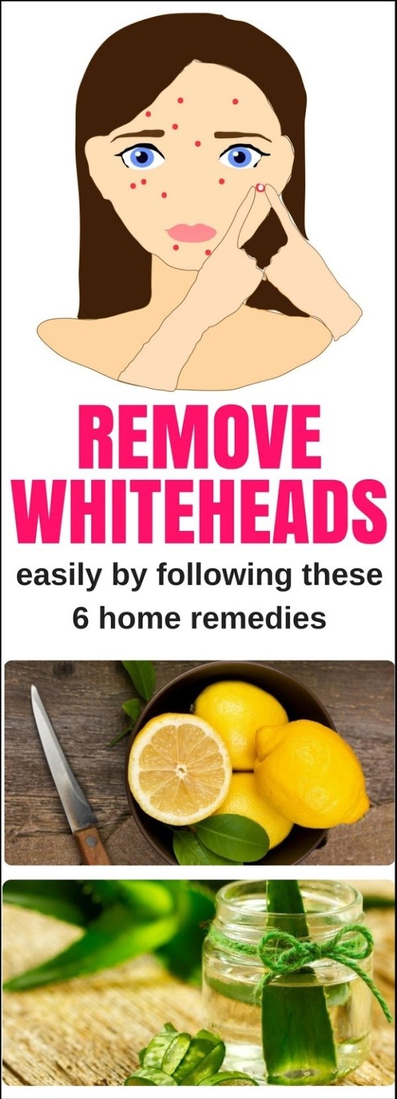 Remove Whiteheads Easily By Following These 6 Home Remedies