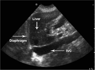 Inferior vena cava