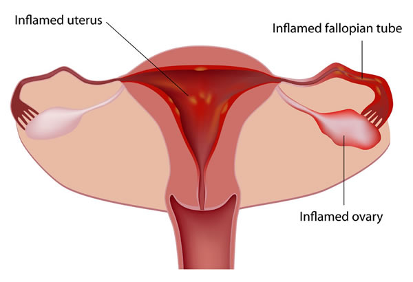 Pelvic inflammatory disease