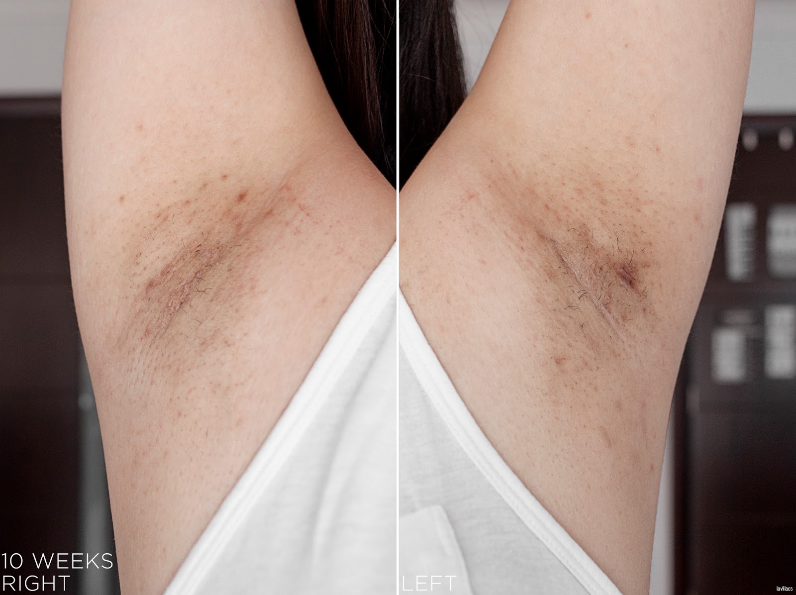 tria Hair Removal Laser Armpits Hair 10 Weeks, 2 months