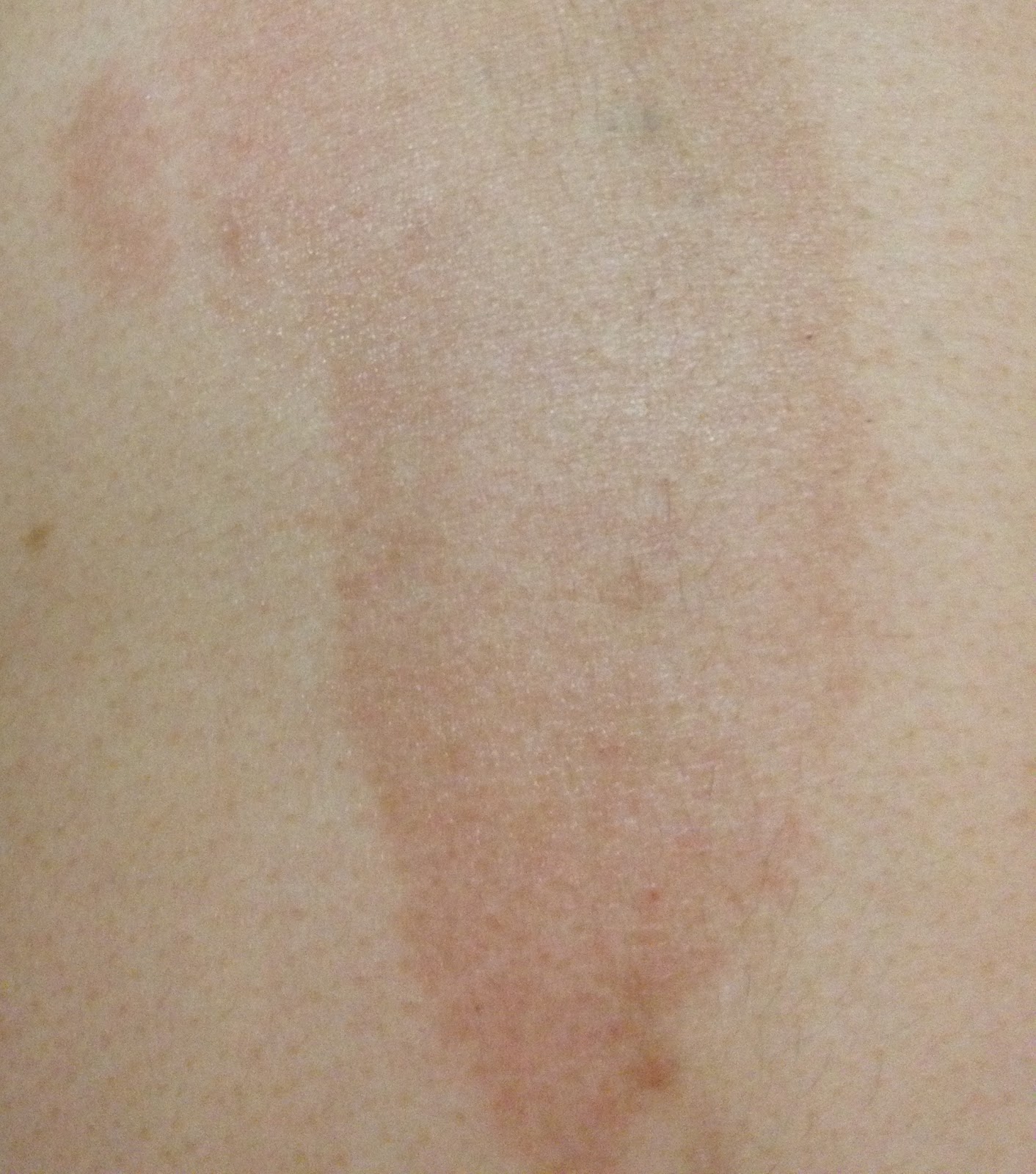 Palmer's cocoa butter. See it used on me! Do not read post if sensitive